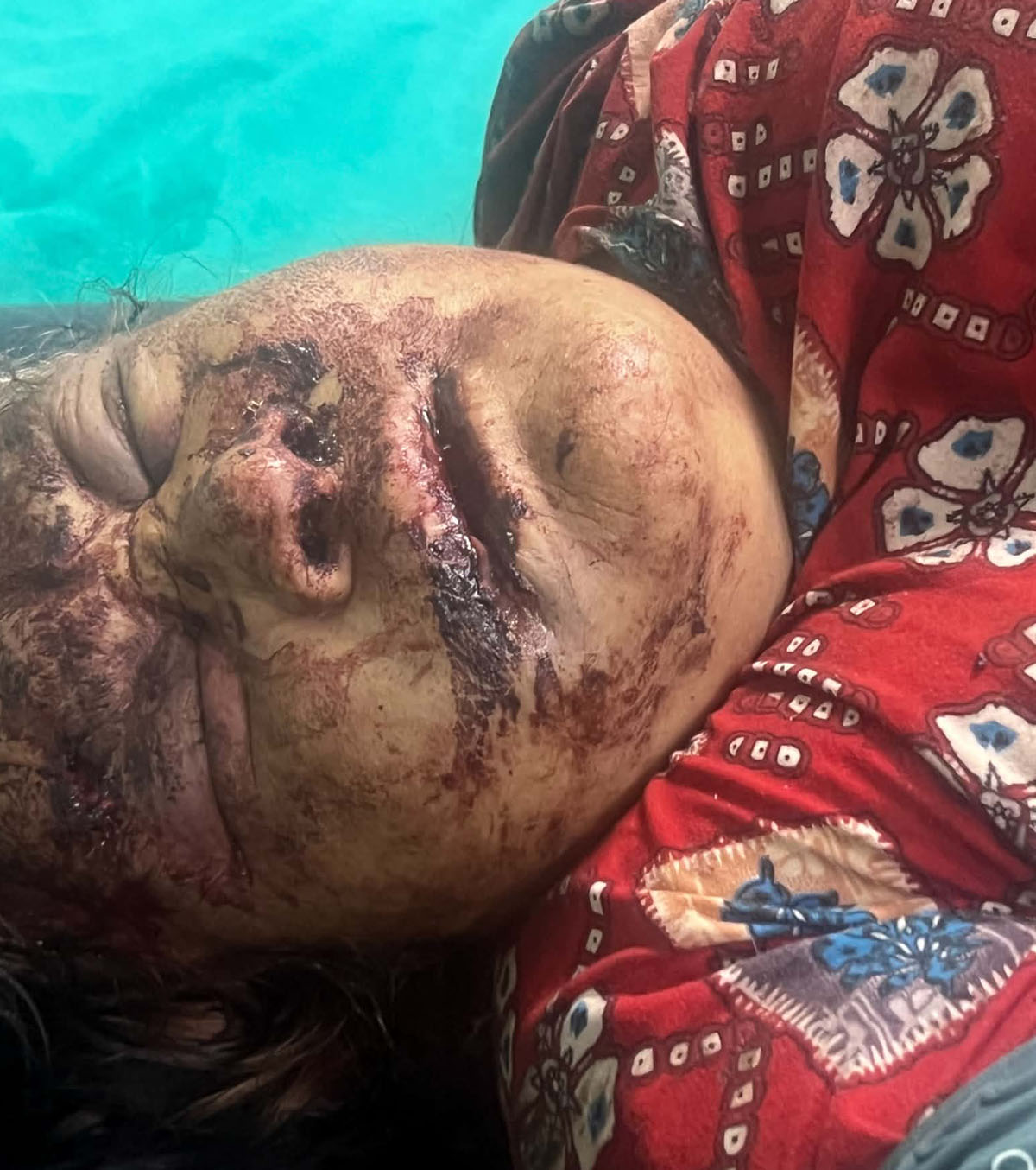 ताथली गोठालेचौरको लुटपाट घटना : पक्राउ परेनन लुटपाटमा संलग्न, घाइतेको अवस्थामा सुधार हुँदै
